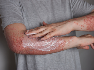 Will Psoriasis Ever Go Away? Exploring Causes, Long-Term Remission & Natural Care