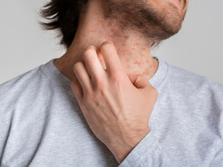 7 Easy Daily Habits to Naturally Manage and Prevent Eczema Flare-Ups