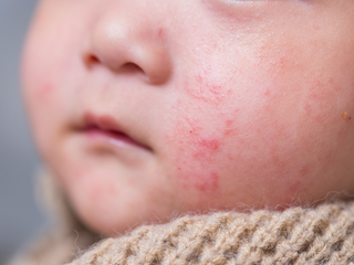 A Mother’s Journey to Finding a Safe Solution for Infant/Baby Eczema Relief