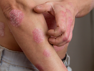 5 Daily Habits to Stop Psoriasis from Spreading