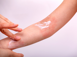 Natural way to treat atopic eczema with holistic care and skin barrier support
