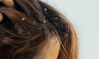 Scalp Psoriasis