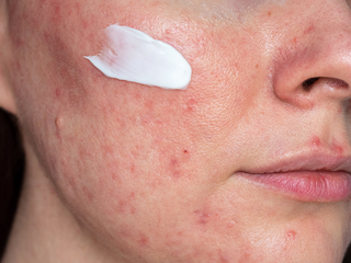 Why ‘Gentle’ Skincare Still Triggers Flare-Ups in Sensitive Skin? Sensitive Skincare Tips