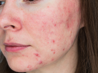 3 Best Skincare Habits Every Sensitive Skin Needs