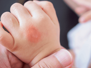 A person holding a baby's hand with eczema rash on it