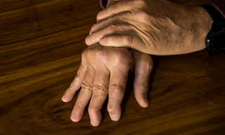 Psoriatic Arthritis