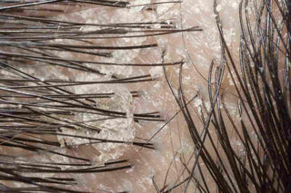 Best way to treat Psoriasis on Scalp and Skin - Oleum Cottage