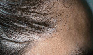 Symptoms of Psoriasis on Scalp - Oleum Cottage