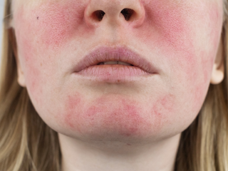 Eczema or Atopic Dermatitis Flare Ups on the Face Leading to Red Itchy Patches