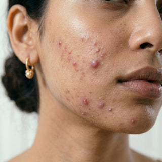 Oleum Cottage Acne skincare collection for pimples, oily skin, post-acne marks, and healthy skin barrier support.