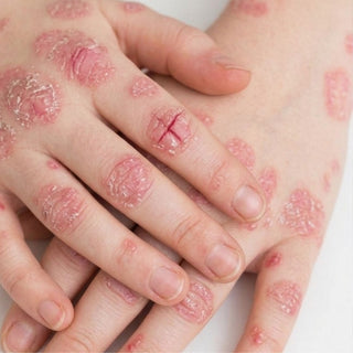 Oleum Cottage Psoriasis skincare collection for itchy, flaky, inflamed skin with products that support skin barrier repair and long-term relief.