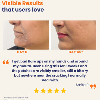 Before and after comparison of a person's face with visible results on acne, labeled 'Day 0' and 'Day 45', with customer feedback and rating.
