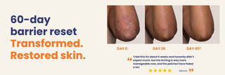 60-day skin barrier repair transformation showing reduced redness, itching, scaling, and visible improvement in psoriasis and eczema patches from day 0 to day 60 with Oleum Cottage's Complete Care Bundle