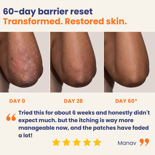 60-day skin barrier repair transformation showing reduced redness, itching, scaling, and visible improvement in psoriasis and eczema patches from day 0 to day 60 with Oleum Cottage's Complete Care Bundle