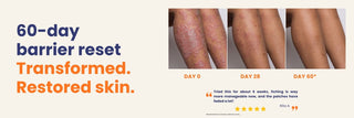 60-day transformation showing before and after results of the Large Patches Bundle with visibly calmer psoriasis-prone skin, reduced itching and healthier skin barrier.