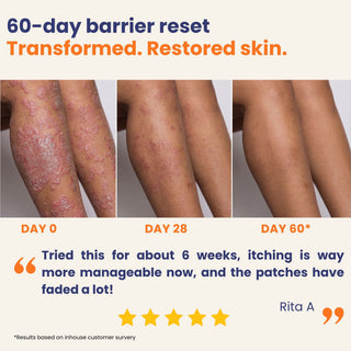 60-day transformation showing before and after results of the Large Patches Bundle with visibly calmer psoriasis-prone skin, reduced itching and healthier skin barrier.