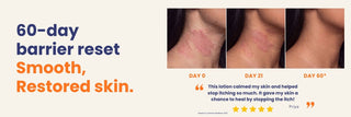 Before and after results using Calming Anti Itch Lotion showing reduced itching and healthier skin after 60 days. Barrier repair lotion for eczema, dermatitis, and chronic dry itchy skin.