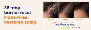 35-day scalp barrier reset showing progressive improvement from day 0 to day 35 with reduced flakes, calmer scalp, itch relief and smoother hair using the Scalp 2 Step Bundle.