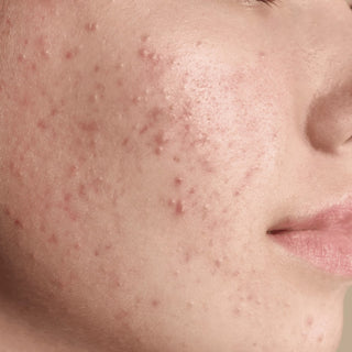 Acne and pimple control products by Oleum Cottage for clearer, balanced, and blemish-free skin.