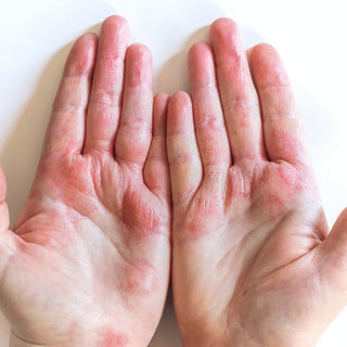 Therapeutic oils and skincare for eczema and rashes, soothing itchy, dry, and inflamed skin naturally.