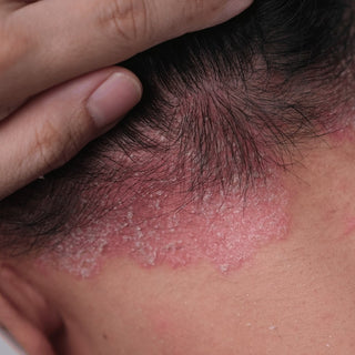 Natural psoriasis skin and scalp care products by Oleum Cottage to reduce redness, itching, and flakes.