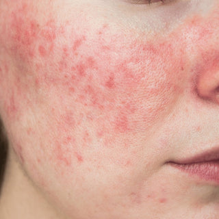 Rosacea and sensitive skin natural care by Oleum Cottage with calming plant-based skincare solutions.
